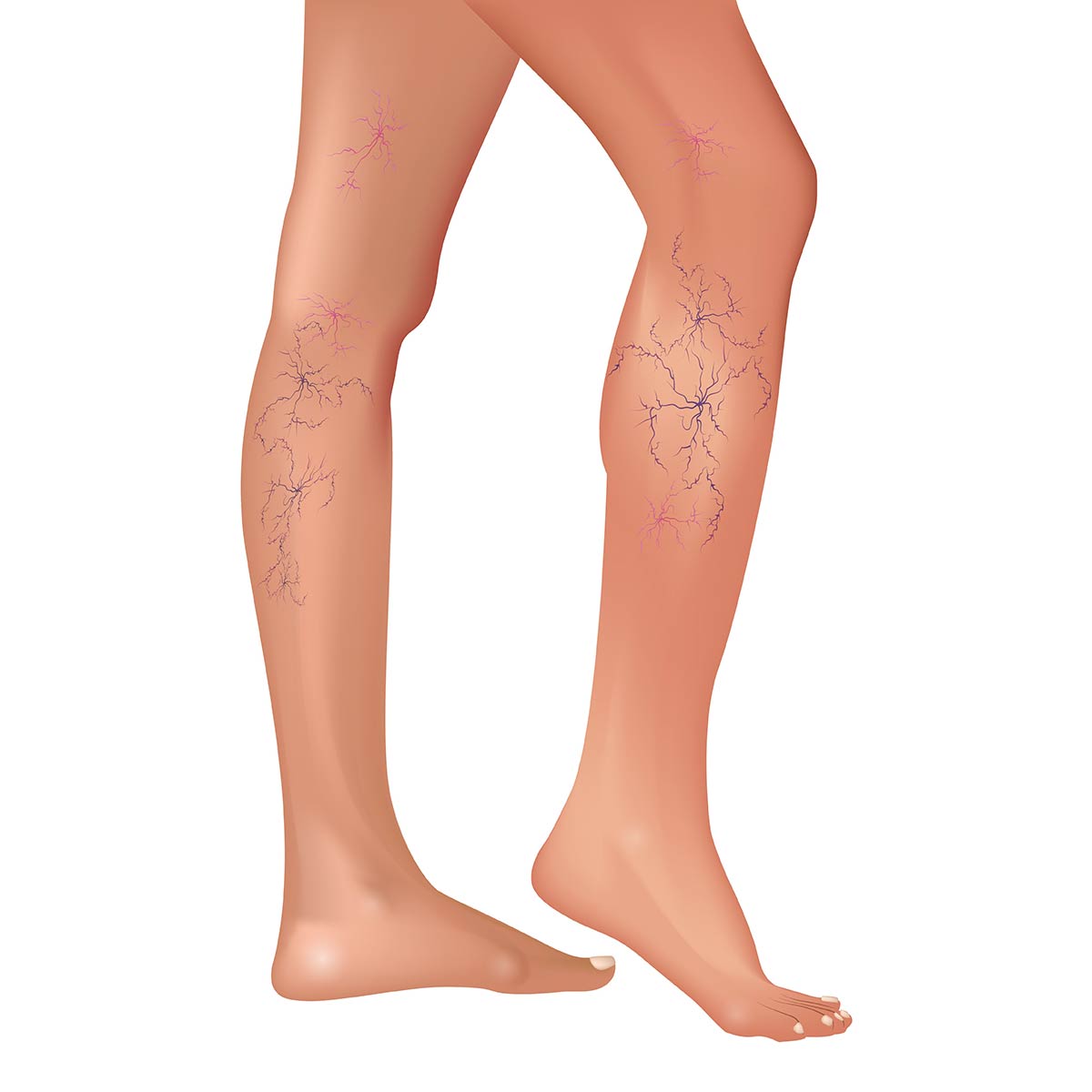 apair of bare legs showing varicose veins